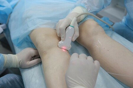 Лазерная операция по удалению вен на ногах