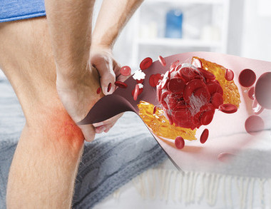 Защита от тромбоза вен ног: как снизить риск и сохранить здоровье Защита от тромбоза вен ног: как снизить риск и сохранить здоровье