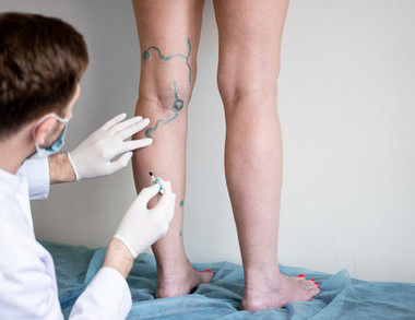 Сравнение склеротерапии и микрофлебэктомии: что эффективнее при варикозе Сравнение склеротерапии и микрофлебэктомии: что эффективнее при варикозе